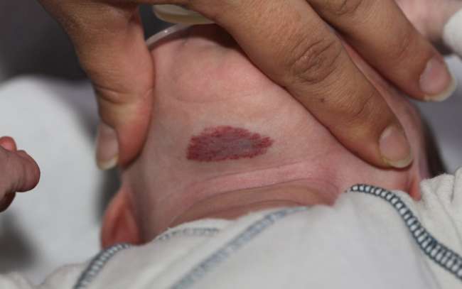 Quali sono i fattori di rischio per la comparsa degli emangiomi?