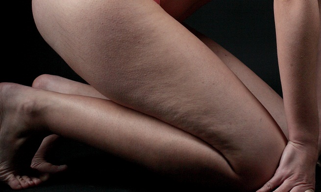 3 rimedi naturali contro le smagliature